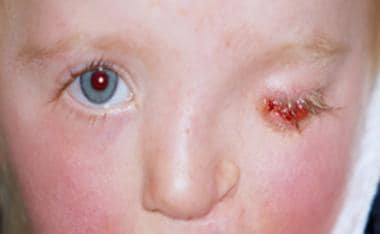 Anophthalmic socket (left eye). 