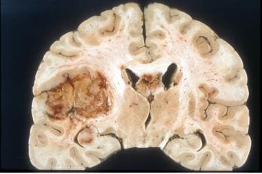 Coronal section of a glioblastoma in the left temp