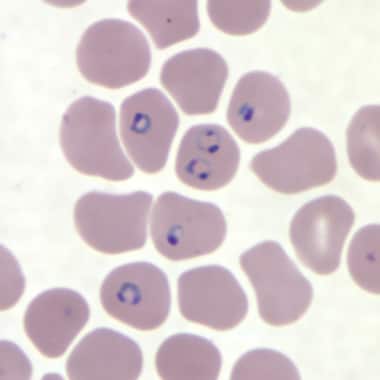 Thin blood smear showing the ring forms of P falci