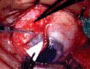 传统glaucoma-filtering手术。