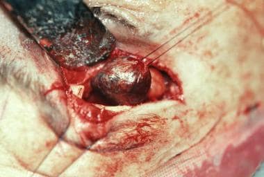 Extirpation of an orbital cavernous hemangioma. No