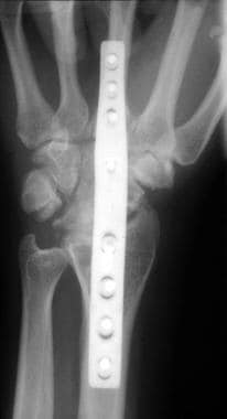 Scapholunate advanced collapse (SLAC) wrist treate