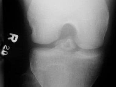 intercondylar fossa x ray