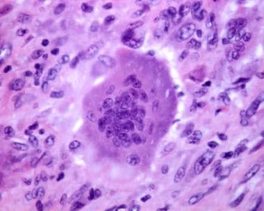 Giant cell tumor. Photomicrograph of multinucleate