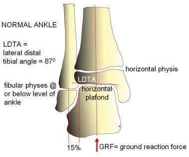 Normal ankle alignment. The lateral distal tibial 