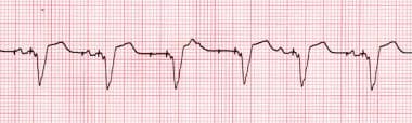 Pacemaker Malfunction. Loss of atrial capture. The