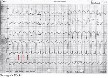 Note the retrograde P waves in this electrocardiog