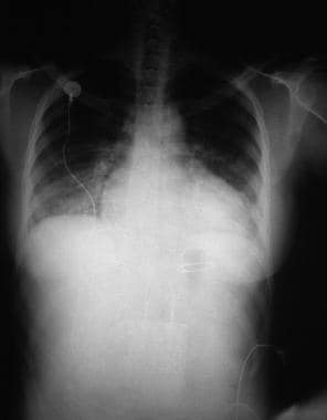 Heart Failure. A 28-year-old woman presented with 