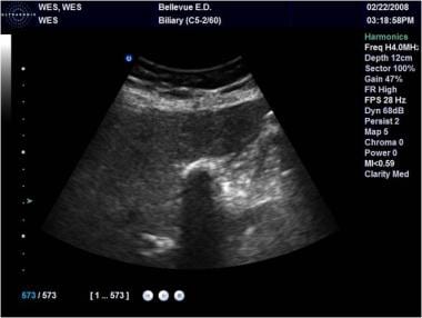 gallstones ultrasound removal