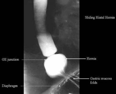 Hiatal Hernia. This barium study shows a sliding h