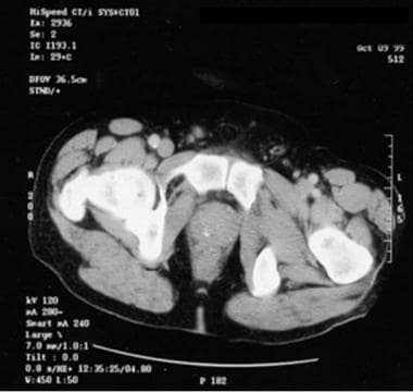 Prostatic calcifications in a male with a urinary 