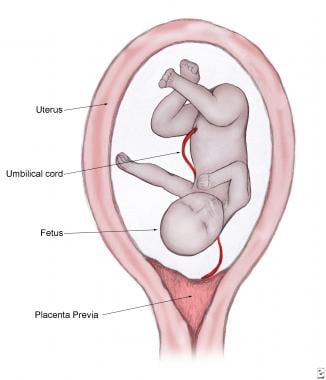 Placenta previa. 