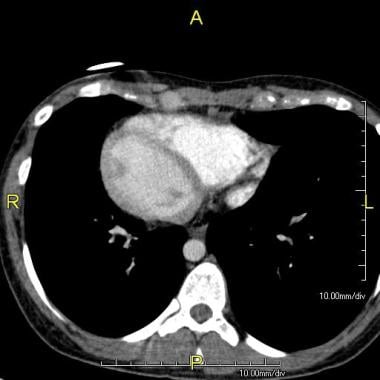 Axial CT image showing dextrocardia and situs inve