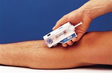 compartment syndrome test kit