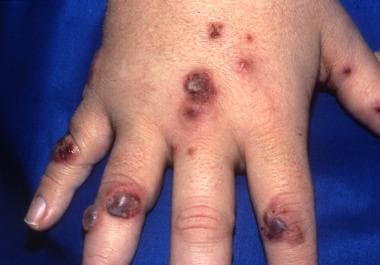 Several necrotic, purpuric, and blistering papules