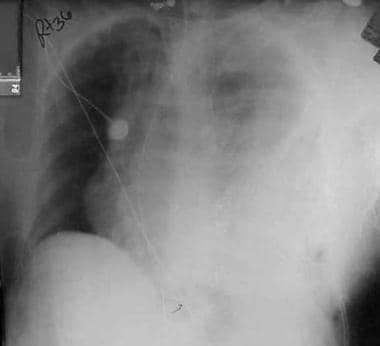 Preoperative chest radiograph in a 53-year-old wom