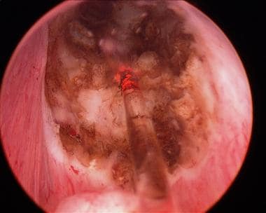Cystoscopic image of vapor-resection of an obstruc