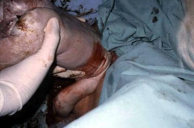 Assisted vaginal breech delivery. The fetal head i