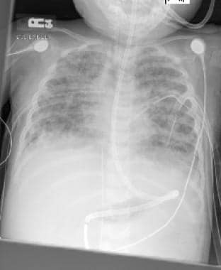 Chest radiograph demonstrates complication of acut