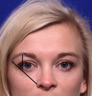 Woman demonstrating ideal brow aesthetics. Note th