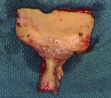 A typical subcranial bone flap. 