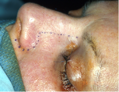 nasal cavity cancer