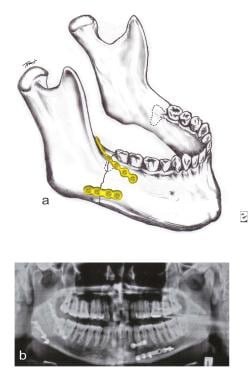 A transverse fracture of the mandible angle withou