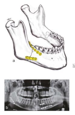 mandible fracture classification