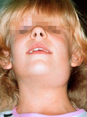 6岁女童患复发性腮腺炎的患儿
