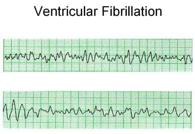 ventricular fibrillation heart