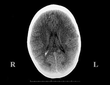 Pediatric Head Trauma. Intraventricular hemorrhage