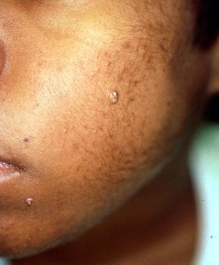 Molluscum Contagiosum: Causes, Symptoms, Treatment, And, 46% OFF