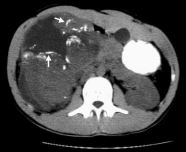 Nonenhanced CT scan demonstrates linear and curvil