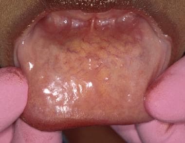 The labial mucosa is typically smooth and glisteni