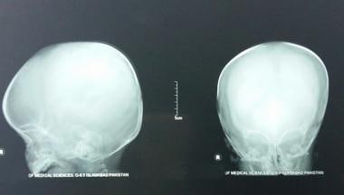 Antero-posterior and lateral views on skull radiog