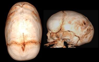 3D reconstruction of child with sagittal craniosyn