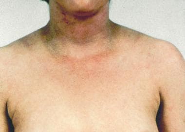 Dirty neck sign in chronic atopic dermatitis. 