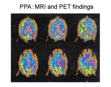 Patient with progressive nonfluent aphasia. Positr