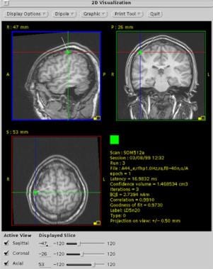 First cortical somatosensory response (N20m) to le