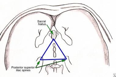 Surface anatomy of caudal block and sacral hiatus 