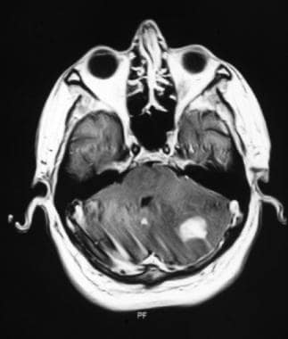 T1-weighted MRI after gadolinium contrast shows a 