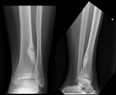 Anteroposterior (AP) and lateral radiographs of os