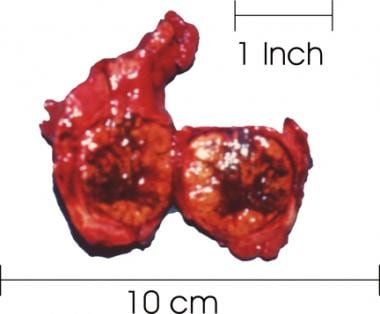 Thyroid with a large goiter. The right lobe of the