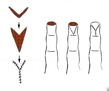 Tissue Flap Classification Classification And Principles Of