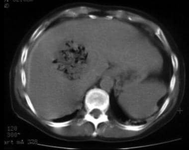 CT appearance of a liver lesion after radiofrequen