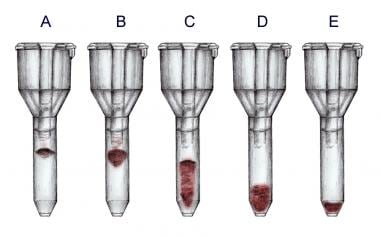 Agglutination Grading Chart