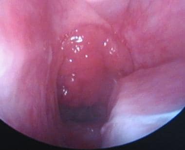 tonsil crypt anatomy