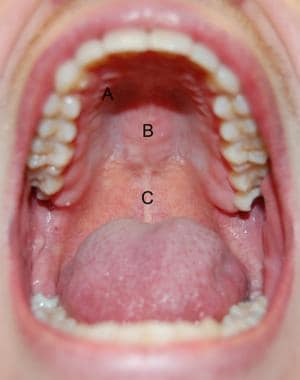 hard palate diagram