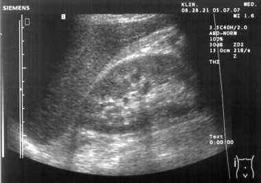 Normal ultrasound of right kidney. Courtesy of Wik