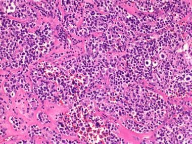 Pathology of Primary Bone Lymphoma. The atypical a